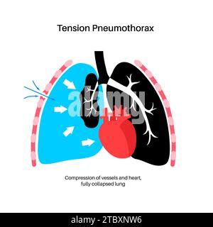 Tension Pneumothorax Illustration Stock Photo Alamy