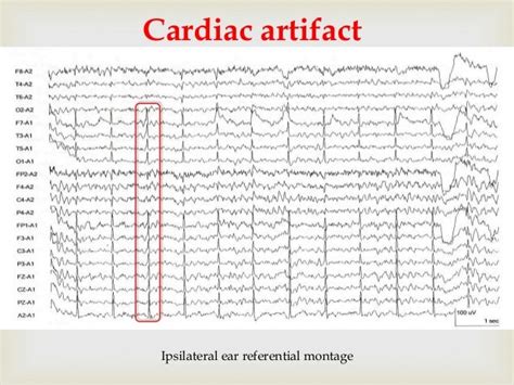 Eeg Artifacts