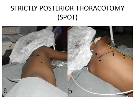 THORACIC INCISIONS a powerpoint for general surgeons | PPTX