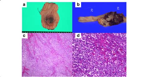 Histopathological Findings Of The Jejunum A The Resected Specimen Of