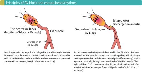 Overview Of Atrioventricular Av Blocks Ecg Learning