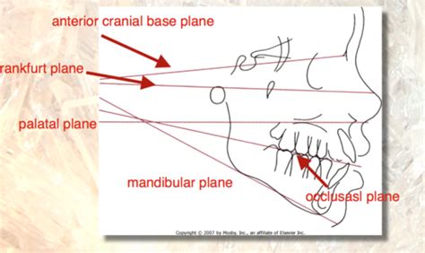 Ortho Midterm Flashcards Quizlet