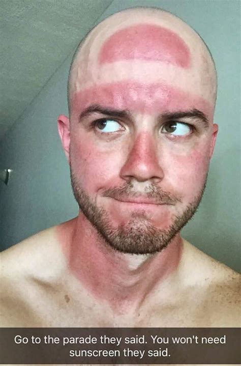 Who Needs A Farmers Tan When You Can Get A Cavs Finals Hat Burn