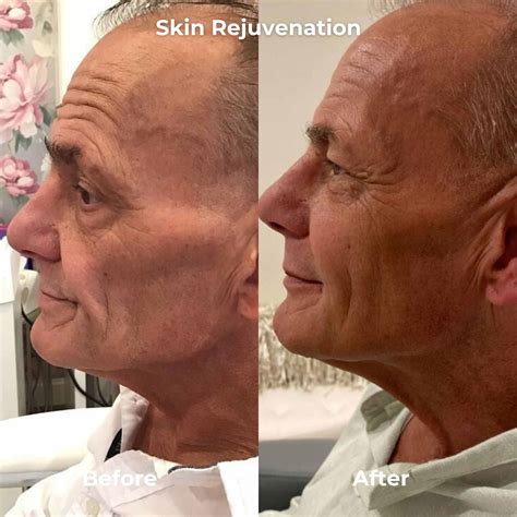 RF Microneedling Before After Results