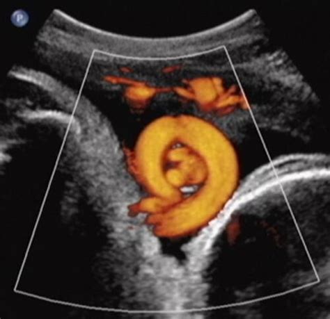 Full Article Current Perspectives Of Prenatal Sonographic Diagnosis