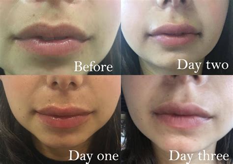 How Long Will Lips Be Swollen After Filler