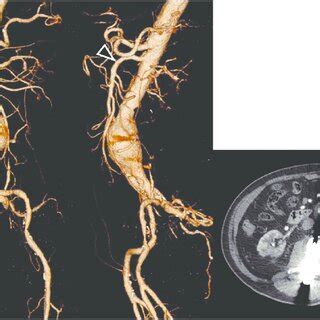 Pre-procedural images: CT images show infrarenal AAA (5.0 cm). There is ...