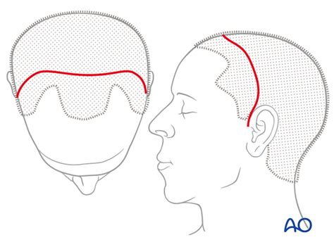 Obliteration For Frontal Sinus Fracture Posterior Table