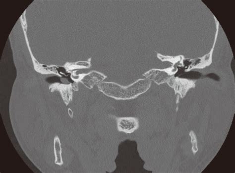 Coronal Temporal Bone Computerized Tomography Without C Open I