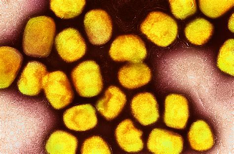 Why The Monkeypox Outbreak Is Mostly Affecting Men Who Have Sex With