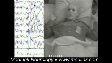 Myoclonic Seizures | MedLink Neurology