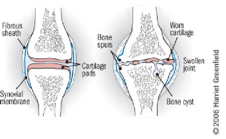 Knee Osteoarthritis Physiopedia