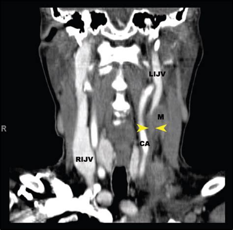 Sonography Of Isolated Internal Jugular Vein Impingement And Thrombosis