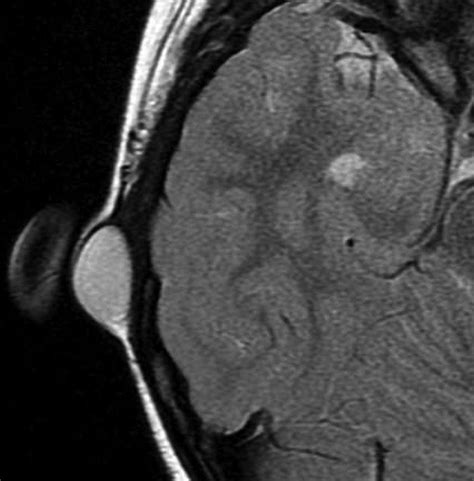 Dermoid Cyst Of The Auricle A Rare Manifestation Bmj Case Reports