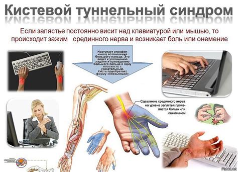 Диета При Туннельном Синдроме — Похудение Диета Правильное Питание