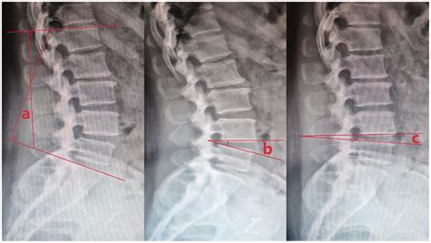 Lateral X Ray Of The Lumbar Spine Showing That The Lumbar Lordosis