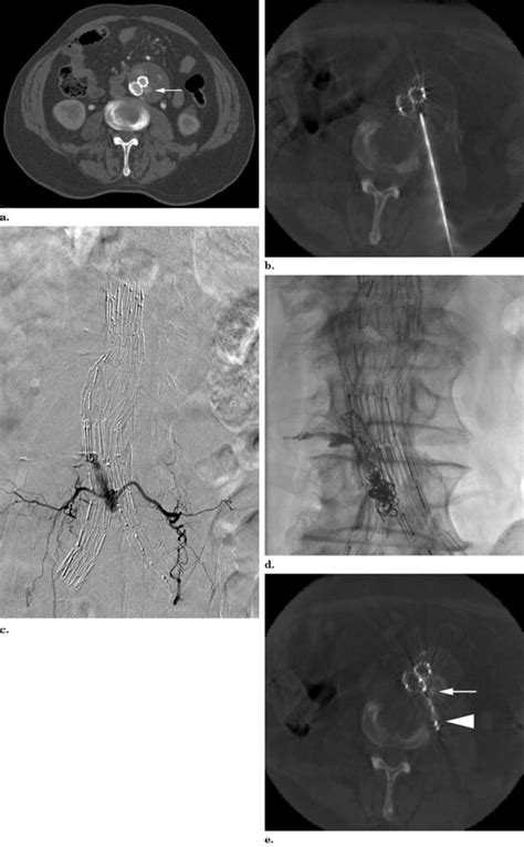 Translumbar Type Ii Endoleak Repair Using Angiographic Ct Journal Of