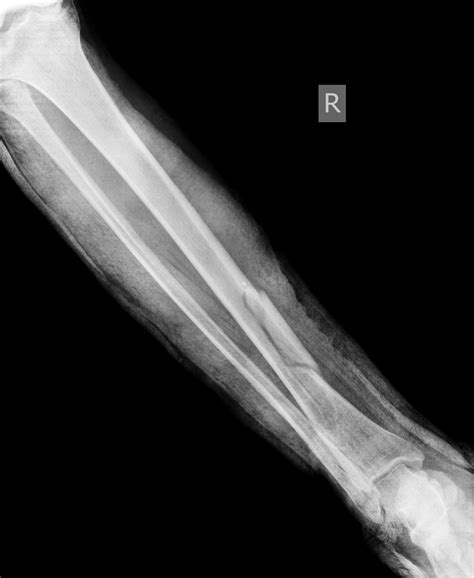 BROKEN ARM 1 - Buyxraysonline