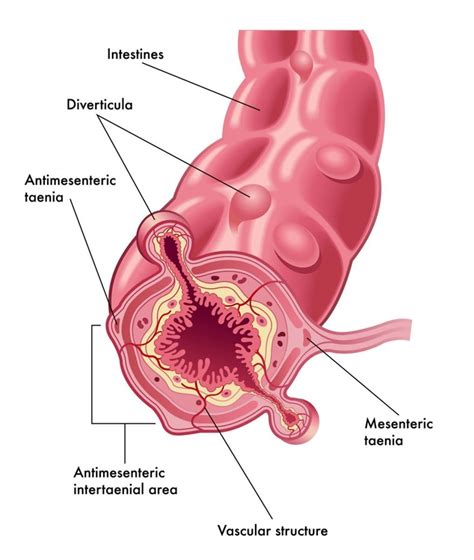 Diverticulitis Vs Diverticulosis