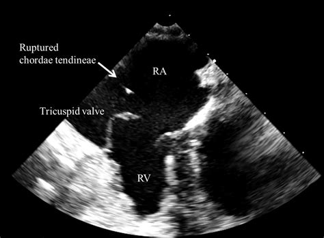 Platypnea Orthodeoxia Syndrome Associated With Spontaneously Ruptured