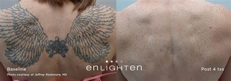 Enlighten Laser Tattoo Removal Better Laser Tattoo Removal