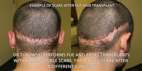 Fut Hair Transplant Before After Photos And Results