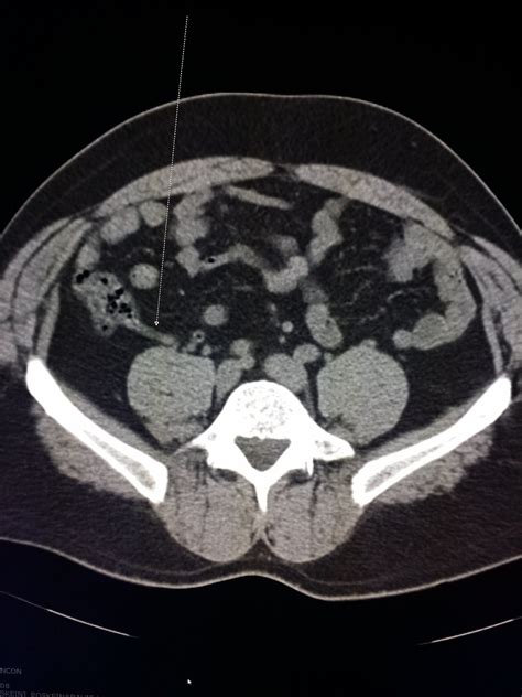 Ct Scan Of The Abdomen And Pelvis Shows A Normal Appendix Sexiz Pix