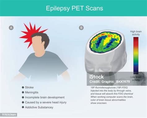 Epilepsi Pet Scan Selsel Otak Jika Gegar Otak Atau Penyakit Epilepsi