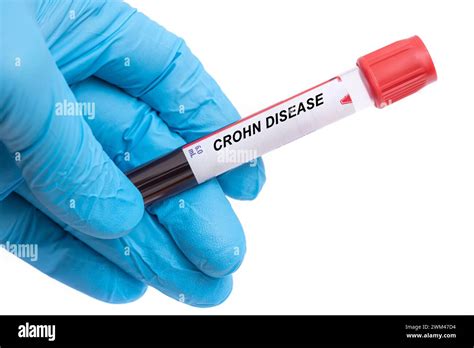Crohn disease blood test Stock Photo - Alamy