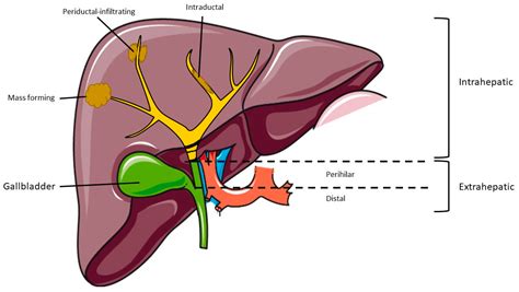 Cholangiocarcinoma Diagram