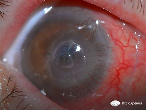 Песок в глазах, симптомы, лечение, признаки, причины.