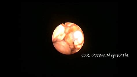 Staghorn Kidney Stone Undergoing Holmium Laser Lithotripsy By Rirs