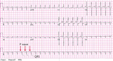 Heart rate 141/min, normal sinus rhythm on 6th hospital day. | Download ...