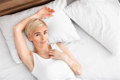 Cheerful Mature Woman With Vitiligo In Bed Portrait Stock Image