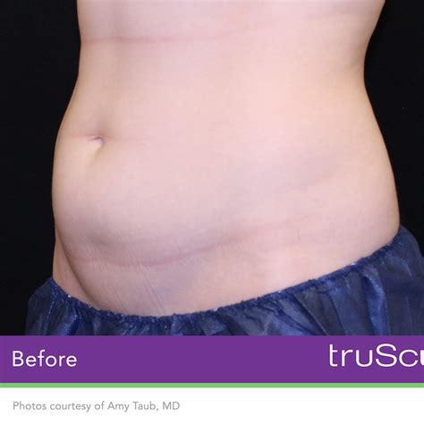 Trusculpt Id Woodland Hills Fat Reduction Elleve Med Spa