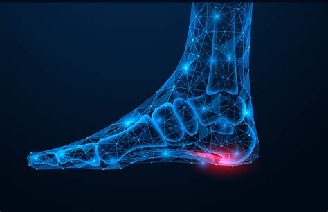 Does Plantar Fasciitis Have to Lead to a Sedentary Lifestyle for