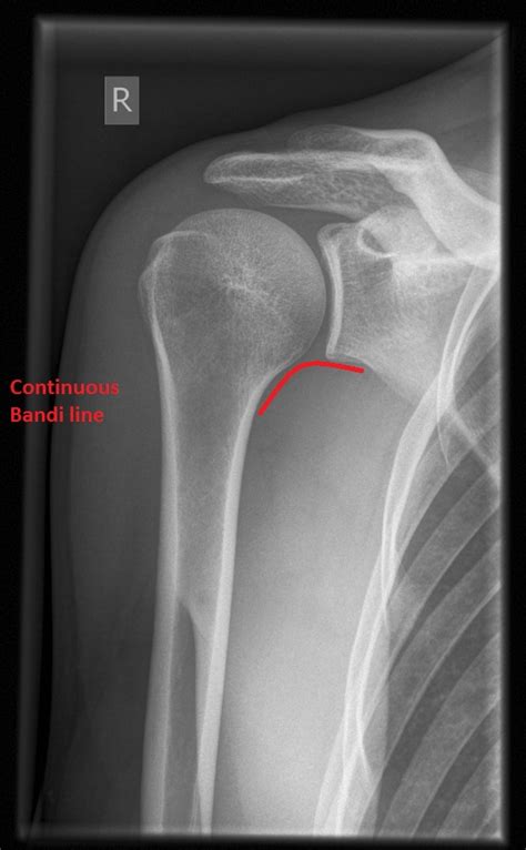 Shoulder x-ray interpretation - WikEM