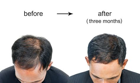 Male Pattern Baldness Reverse It Naturally Hair Stimulator Amazing Hair Growth Results