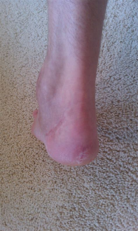 Sprained Ankle Leads to Surgery, CRPS, Amputations, and Disability: 2011