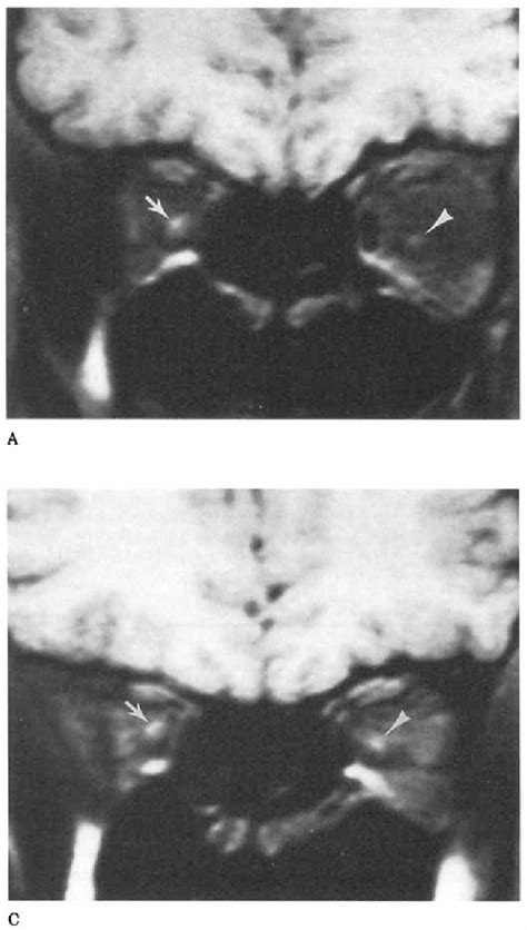 Figure 1 From Mri Of Optic Nerve Enlargement In Optic Neuritis Semantic Scholar