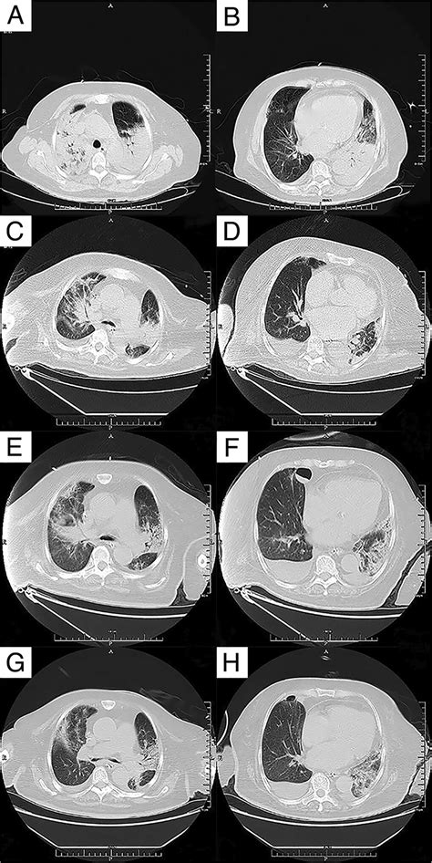 Chest Computed Tomography Findings In Case 1 Which Were Examined At