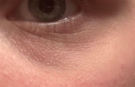 Advice On How To Get Rid Of These Little Bumps Under Eyes And Help Dark Circles Rskincareaddicts