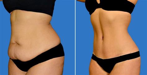 Loose Skin Removal Surgery Costs Scars And Risks Skincarederm