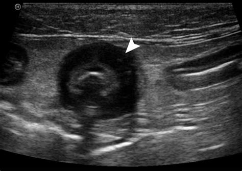 Ultrasonography Of The Gastrointestinal Tract Ileum Cecum Colon