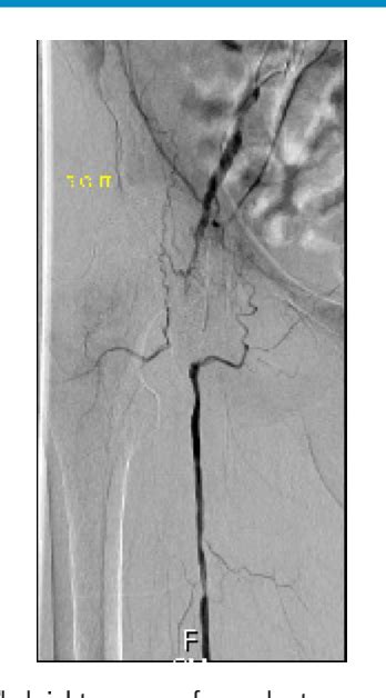 Figure 1 From Leukemoid Reaction Causing Arterial Thrombus In A Patient