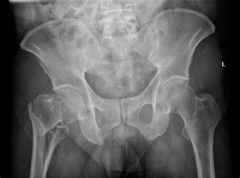 Intertrochanteric Fracture