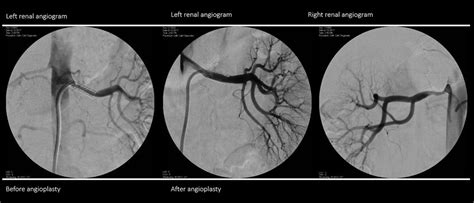 Renovascular Hypertension Hypertension