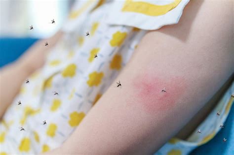 У маленькой девочки аллергия на кожную сыпь и зуд на руке от укуса ...
