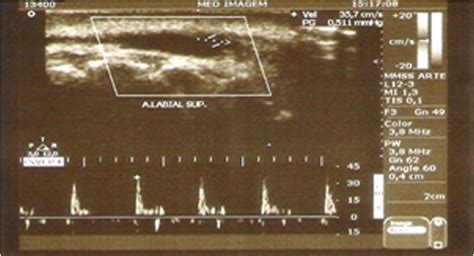 Figure 1 From Aneurysm Of The Superior Labial Artery Semantic Scholar