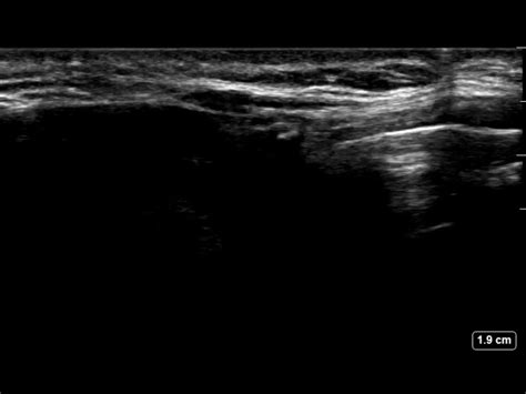 Ultrasound Transverse Taca View 4